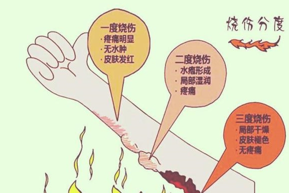 孩子|家长切勿马上送医,应先做好这四步应急处理!孩子意外烫伤