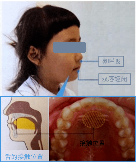 也会影响上颚的发育,使硬腭弓变窄