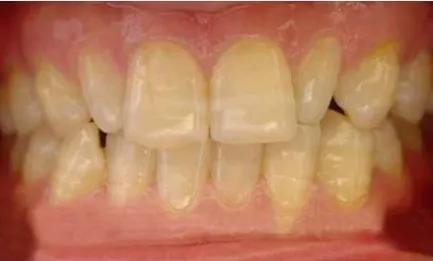 梦境解析,梦见牙齿掉了——探寻内心深处的隐秘信号 梦境解析,梦见牙齿掉了——探寻内心深处的隐秘信号