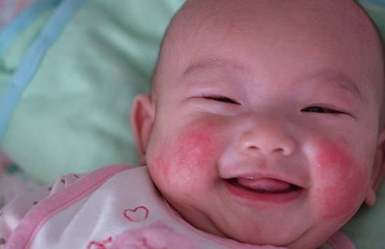 皮肤|护肤怎么做？宝宝秋季皮肤干燥