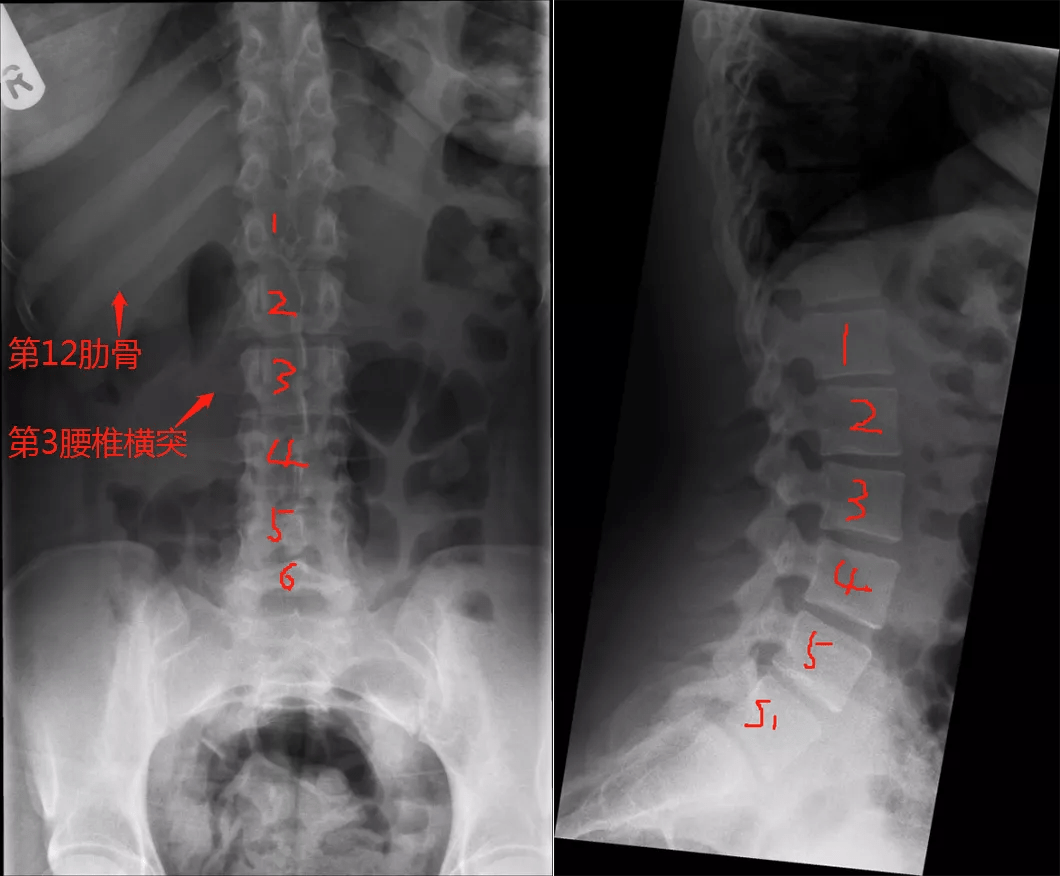腰骶骨移行椎,你是如何判断的?