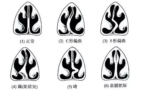 鼻中隔偏曲有什么影响