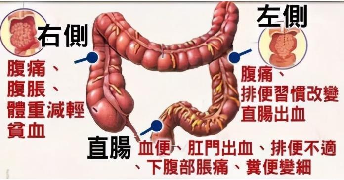 吃得越好,腹部是否隐隐作痛,竟是这种"富贵病"_直肠