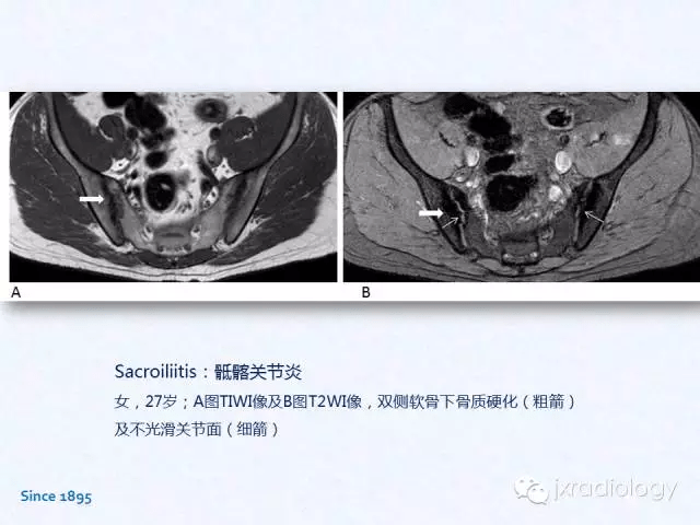 骶髂关节炎:x线,ct和mri表现