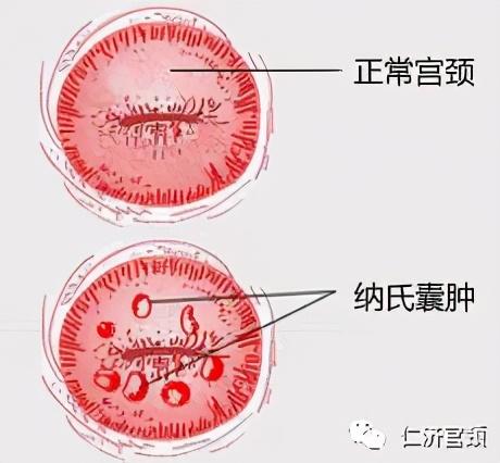 体检发现宫颈囊肿怎么办?