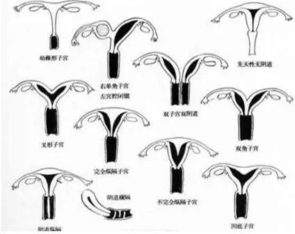 副中肾管衍生物融合障碍所致的异常,如双子宫,双角子宫,弓形子宫,中隔