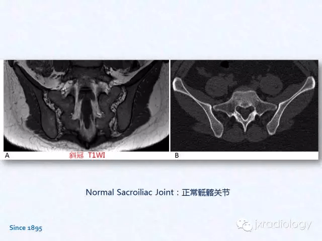 骶髂关节炎:x线,ct和mri表现