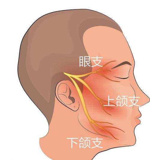 什么是三叉神经痛的原因 504bbd03ce2b4dac9112356f8f251918.jpeg