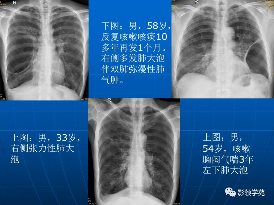 肺气肿的影像诊断