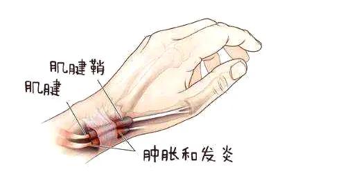 人均腱鞘炎_手腕腱鞘炎图片