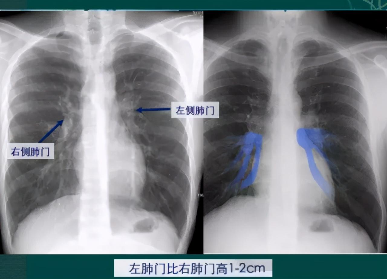 胸片入门攻略,看完不信你还学不会!_右肺