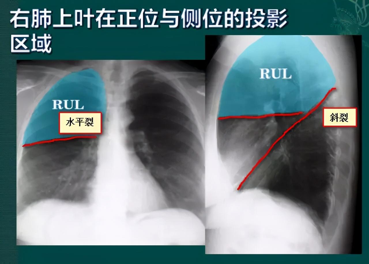 胸片入门攻略,看完不信你还学不会!