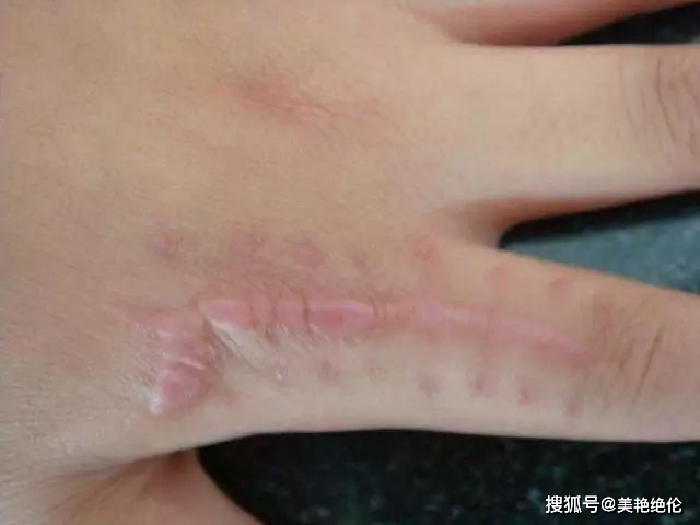 颜次方小知识：列举对疤痕有好处的食物