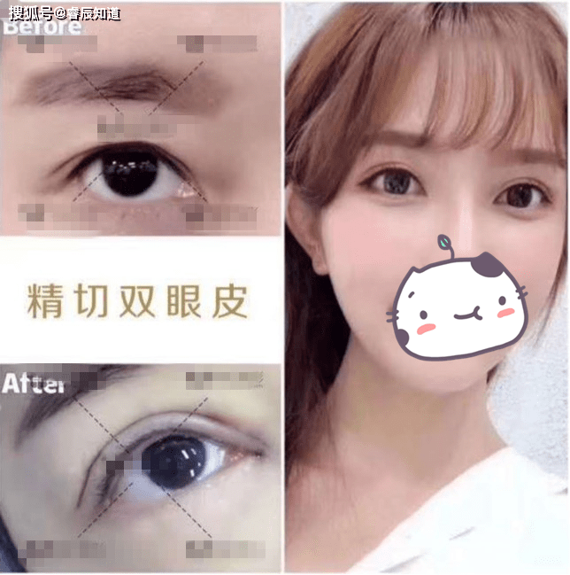 为什么双眼皮肉条感很重 b6e0a2c3244441a9a53a0b22f962df08.png