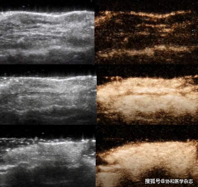 成像|北京协和医院超声医学科杨萌发表于ULTRASOUND MED BIOL的研究