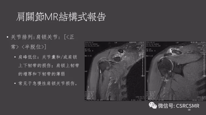 肩关节mri报告如何规范书写