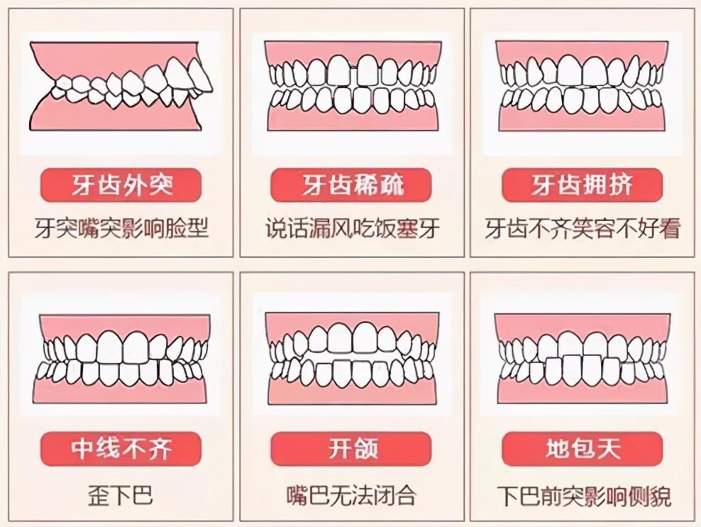 你真的了解你的牙齿咬合吗?四个小动作,检查出你的牙列是否正常_影响