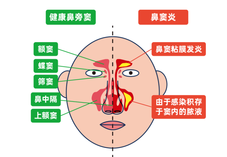 孩子打喷嚏流鼻涕怎么办