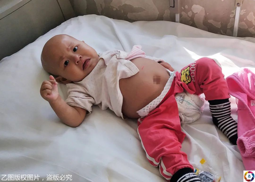 怪物|大如气球,妈妈心痛却束手无策四川2岁小萝莉肚里长“怪物”