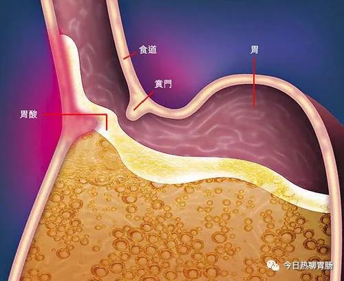 三,脾胃湿热证