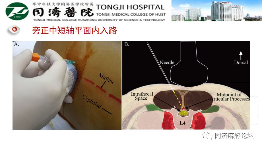 实时超声引导腰麻