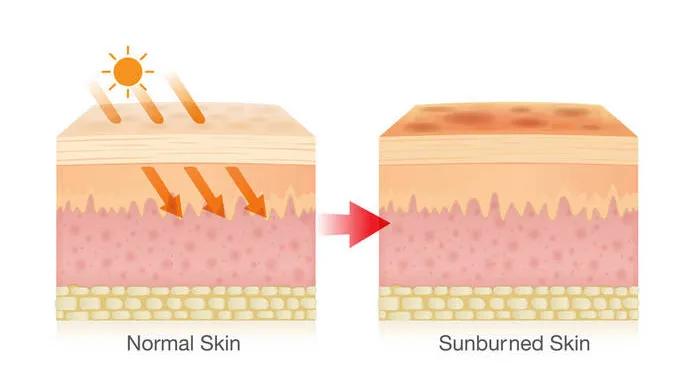 光老化是由于皮肤长期受到日光照射所引起的损害,表现为皮肤粗糙,增厚