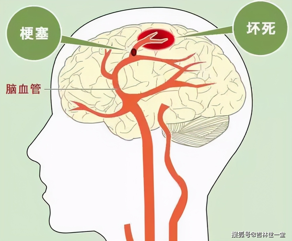 世一堂三一方法：什么样的人容易得腔梗？如何预防和调理腔梗？