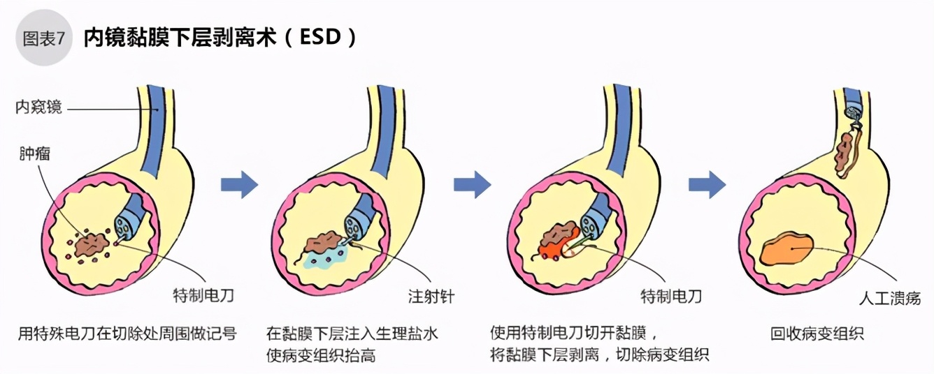 胃癌的内窥镜治疗