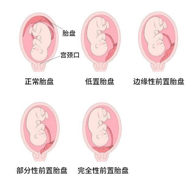 原创前壁胎盘前置胎盘关于胎盘的术语你读懂了吗