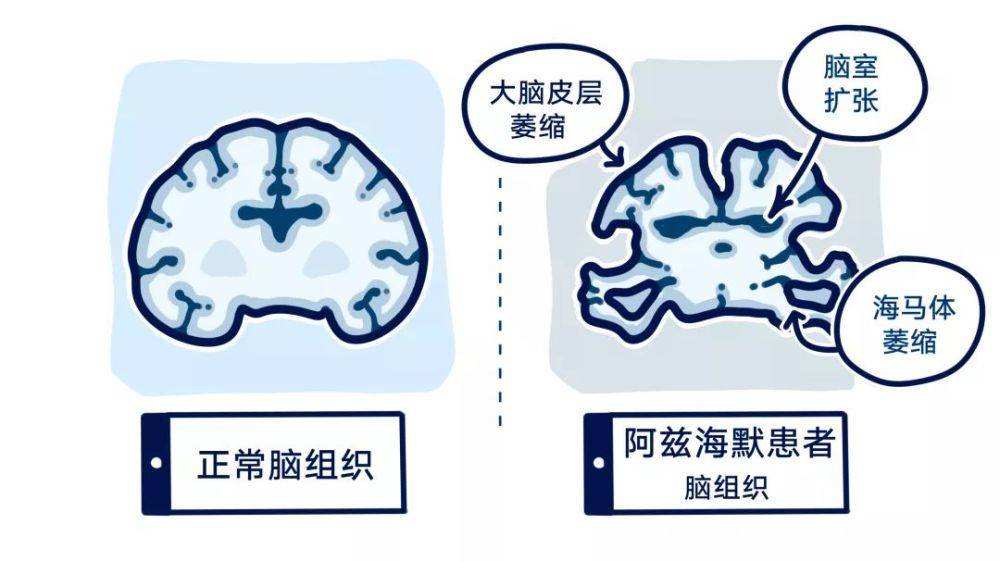 直播预告|阿尔兹海默病公益直播