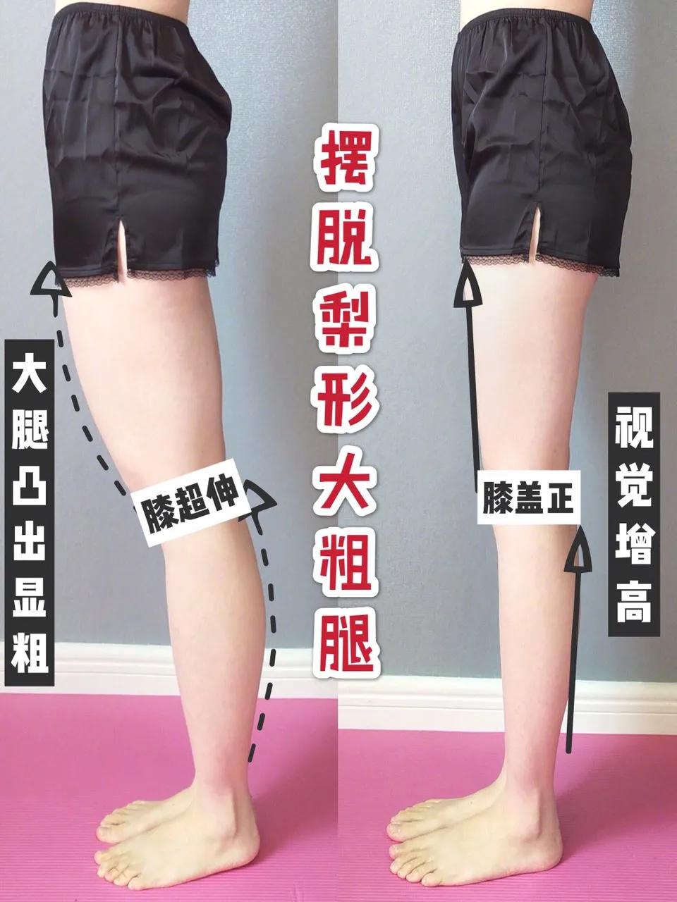 腿型管理腿不直改善各种不良腿型