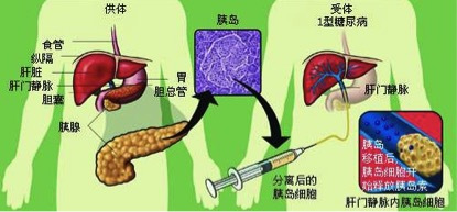 糖尿病怎么治疗不用打胰岛素 a4546bb715364e69996cc502a7acfb6c.jpeg