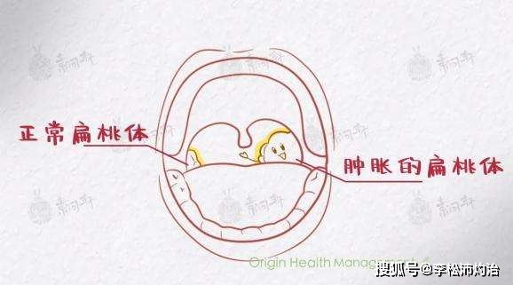 儿童或者成人扁桃体肥大是什么原因造成的常见原因分析