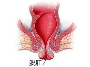 30岁宝妈产后痔疮总治不好肉球越长越大肛门肿物脱出除了痔疮还可能是