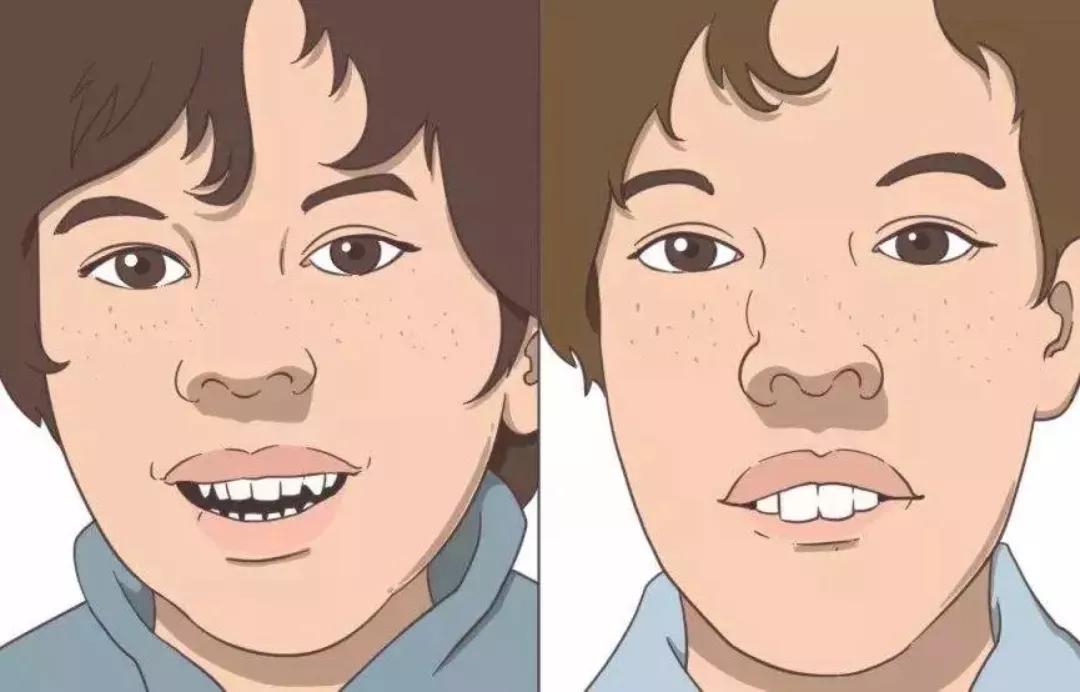 贵阳铭仁耳鼻喉医院:9岁男童牙齿不整齐去矫正,竟然是腺样体肥大惹的