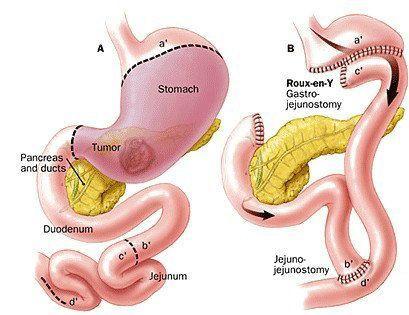 怎么样才能减少胃酸过多 ad8c8af0dc9746ccbcf249d2092cf560.jpeg