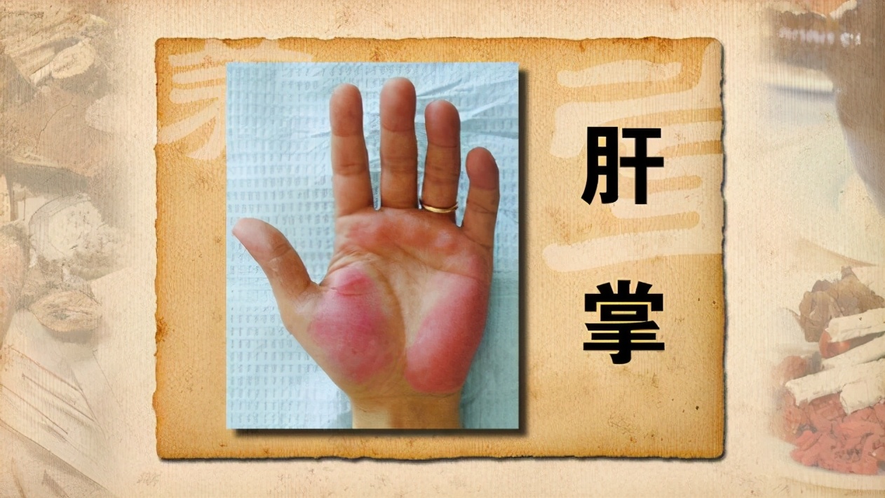 肝掌:慢性肝炎以及进一步肝硬化后,患者手掌大拇指和小指的根部大小
