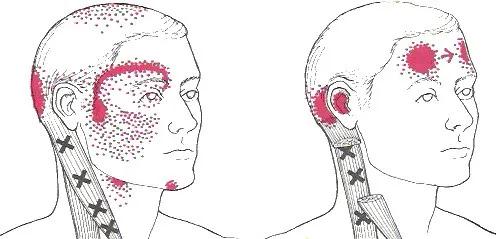 如何快速治疗落枕脖子疼 7e8cc28cff40417dab748697d5507b88.jpeg