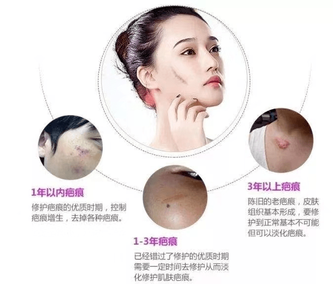 手术疤痕怎么修复最好 12f0d8588e8f41d0b5cb4809ea5c4114.png