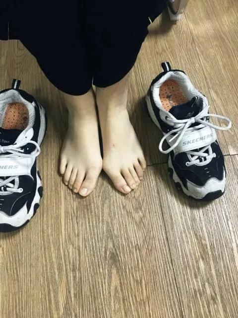 众多女明星都逃不掉的"拇外翻"是什么疾病-搜狐大视野-搜狐新闻