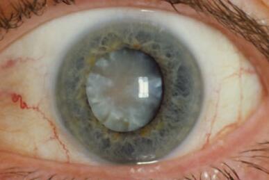 什么是青光眼 13948482eb5a4b8488000fe97c6bbd8b.jpeg