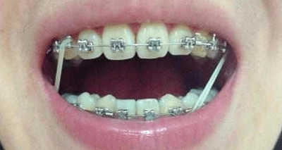 牙齿矫正戴橡皮圈是一种什么样的体验?