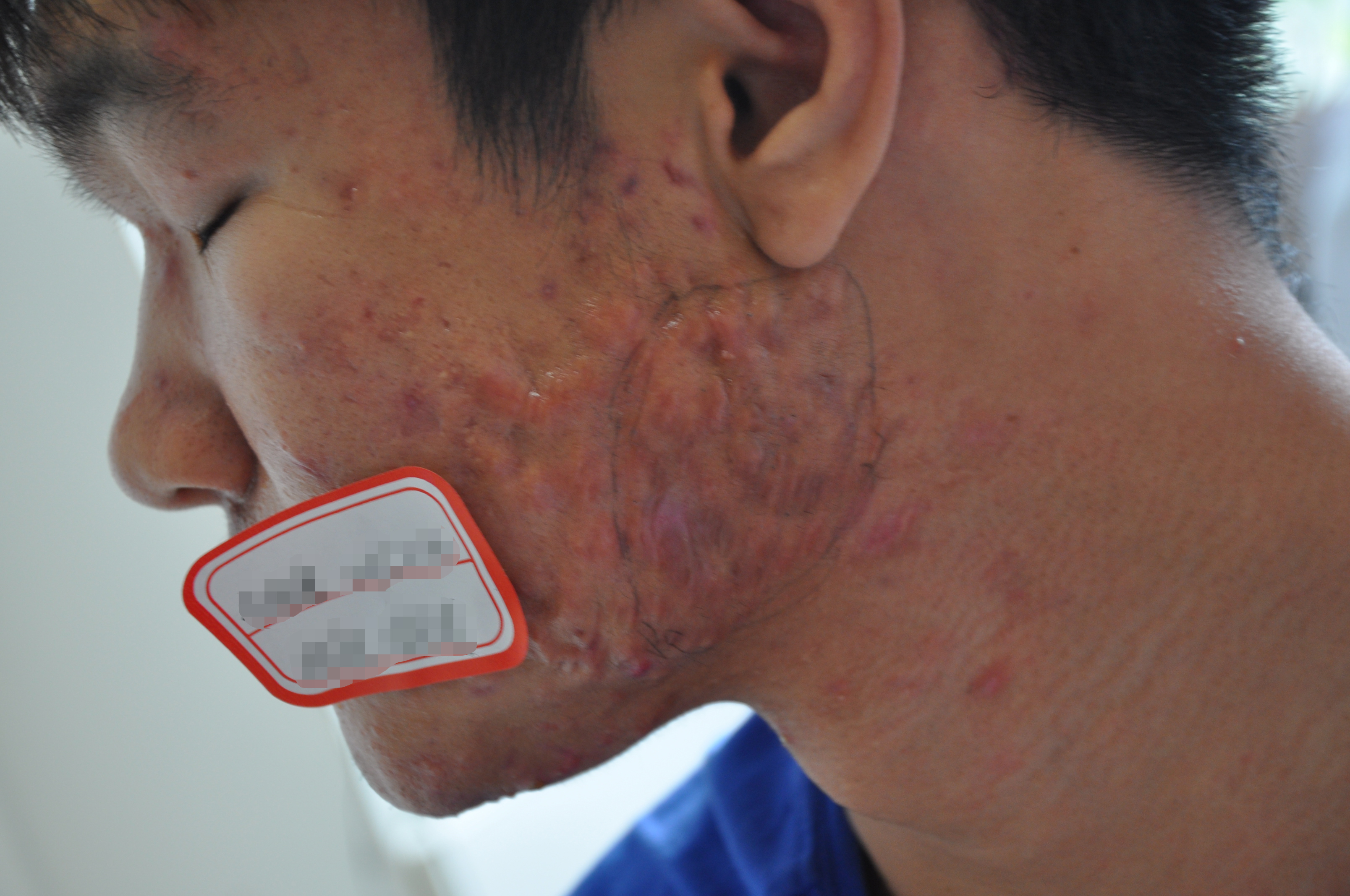 痤疮疤痕(acne scars)是由青春痘痤疮在恢复后所留下的疤痕;是由于