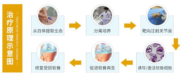 富血小板血浆prp让大量患者摆脱膝关节病痛的折磨