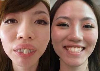 教你分辨龅牙,嘴凸,歪脸,是"牙性"还是"骨性"?