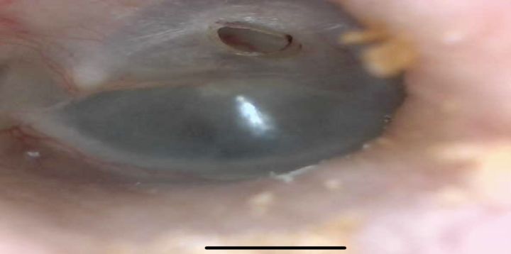 这个图片是客户自己掏耳道导致鼓膜穿孔