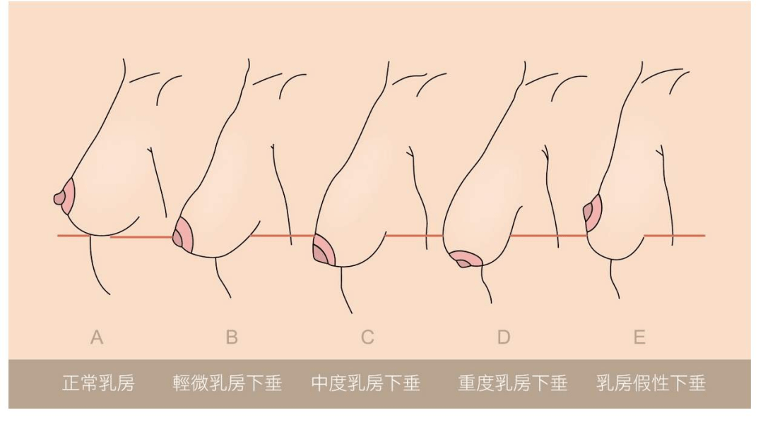 原创雅衣曼体-产后乳房缩水 下垂,如何预防和恢复?