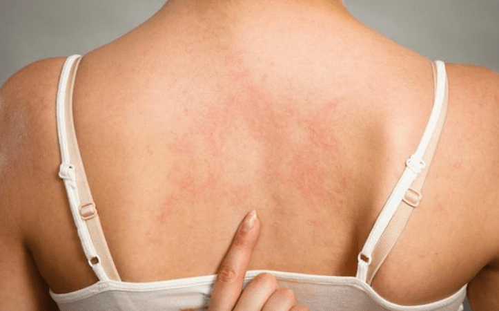 皮肤干燥怎么回事中医 5d0f498909a04570b5e4e7b38236d765.png