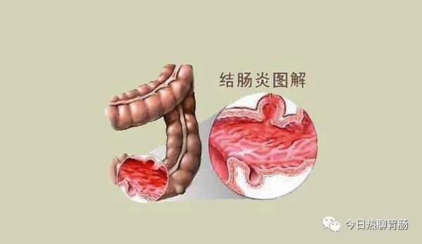 得了慢性结肠炎,这些异常表现就会一一出现,需对症下药