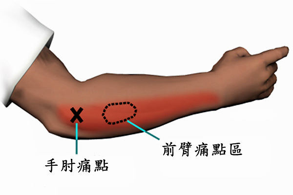 网球肘疼痛怎么治疗怎么恢复